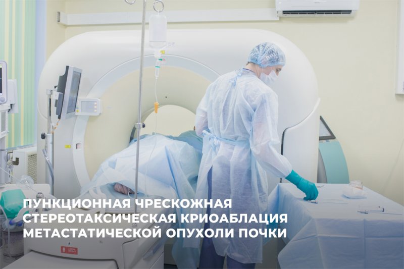 «Пункционная чрескожная стереотаксическая криоаблация метастатической опухоли почки»