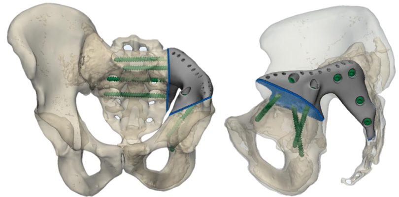3D-эндопротезирование и хирургия: как в НМИЦ онкологии им. Н.Н. Петрова ставят пациентов на ноги